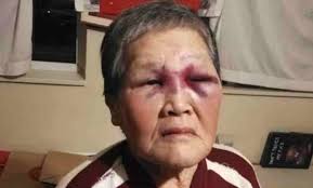 76-year-old Xiao Zhen Xie's black eye she got after a suburban thug sucker punched her;
