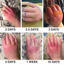 The stages of the rash during margarita burn;