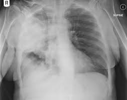 X-Ray image of Streptococcus Pneumonia around the lungs;